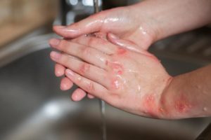 hands patient suffering from eczema